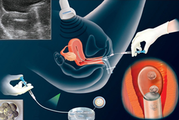 Embryo transfer